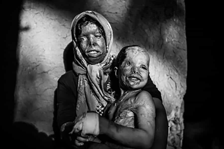 از مجموعهی «قربانیان عشق اجباری» (اسیدپاشی) − عکاس: ابراهیم نوروزی