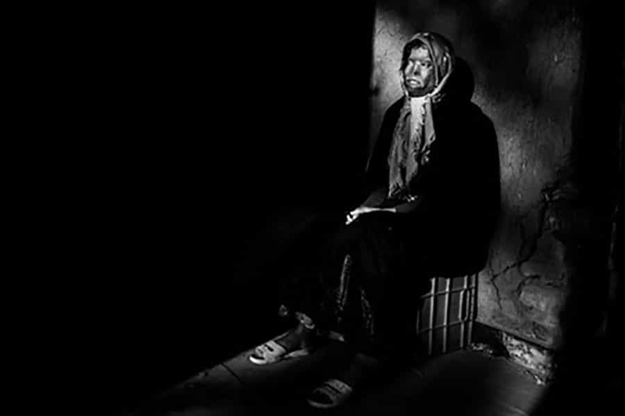 از مجموعهی «قربانیان عشق اجباری» (اسیدپاشی) − عکاس: ابراهیم نوروزی