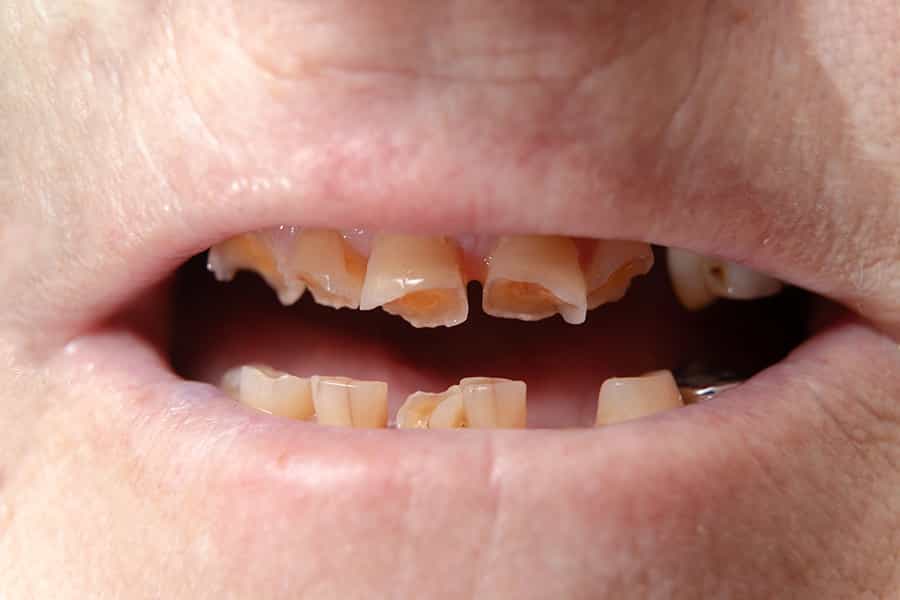 وضعیت دندان، از نشانههای کیفیت بهداشت و درمان و شکاف طبقاتی در هر کشوری است. عکس از Shutterstock