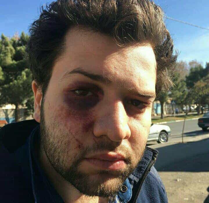 مزدک زرافشان، پس از آزادی به قید کفالت. آثار خشونت مأموران بر چهره او آشکار است.